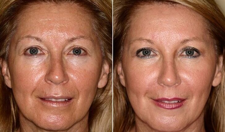 prije i poslije pomlađivanja kože lica kod kuće