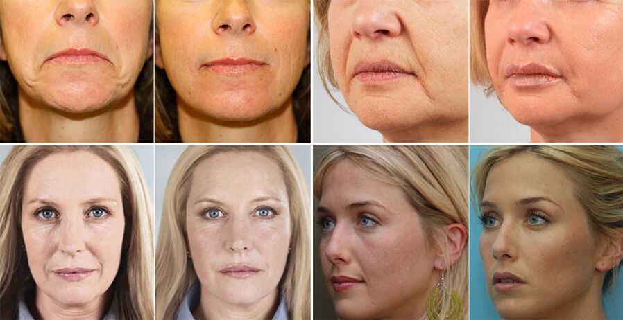 fotografije žena prije i nakon pomlađivanja kože lica