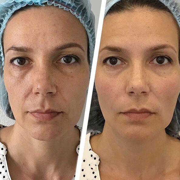 fotografija lica prije i poslije laserskog pomlađivanja